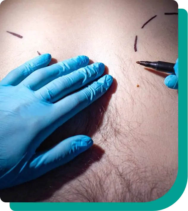 Dr. Wendell realizando procedimento de ginecomastia